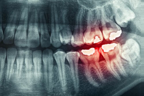 Bruxism