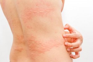 Three Natural Remedies for Hives