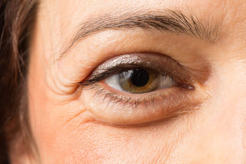 Eliminate dark circles