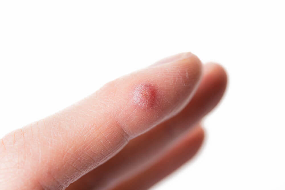 5 Solutions to Remove Warts on Your Fingers