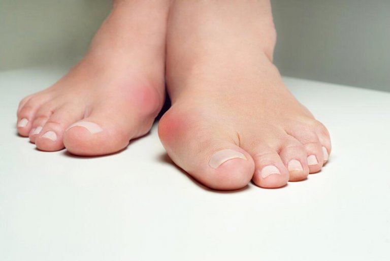 5 Herbal Remedies That Help Fight Bunions