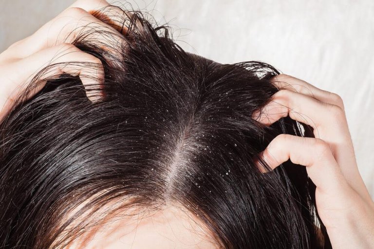 The 6 Best Remedies for Fungal Infections of the Scalp
