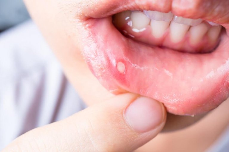 7 Homemade Remedies to Cure Canker Sores
