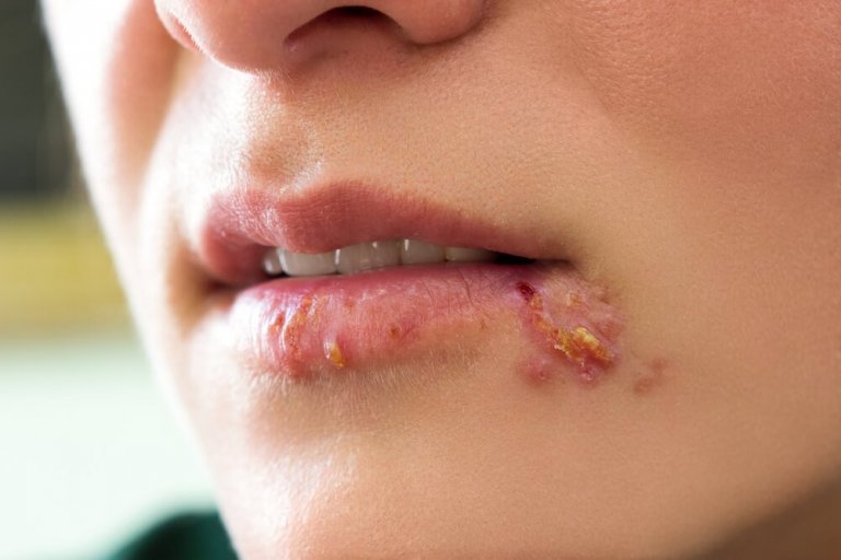 How to Treat Herpes in Children