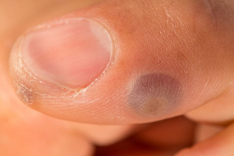 Freezing is a good solution for warts on your fingers.