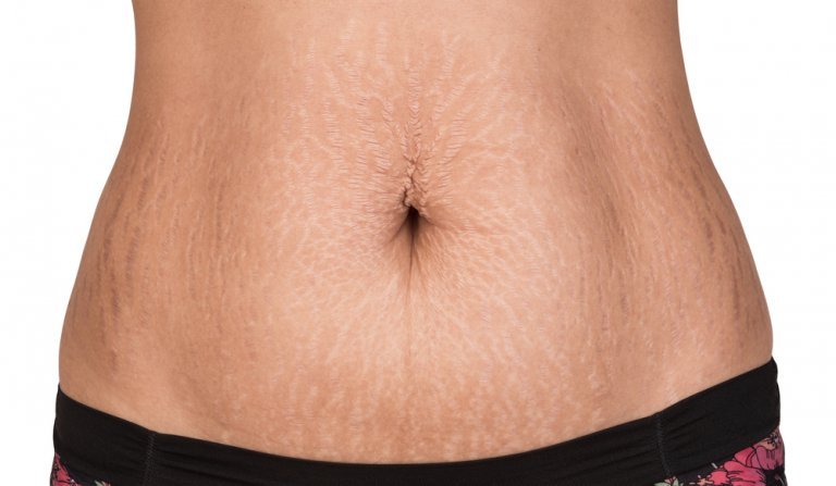 Natural Treatments for Fighting Stretch Marks
