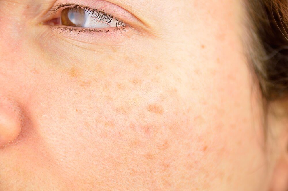 Spots on face