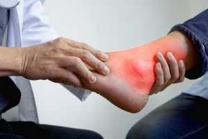 The Best Natural Remedies for Inflammation