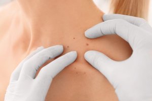 How to Prevent and Treat Warts Through Your Diet