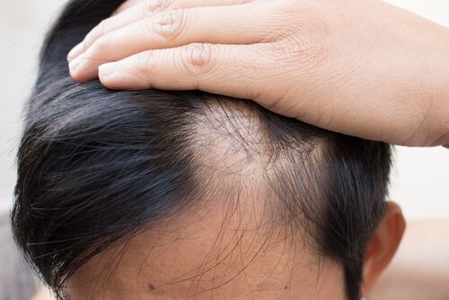 Treat Alopecia