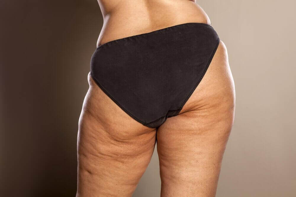 cellulite
