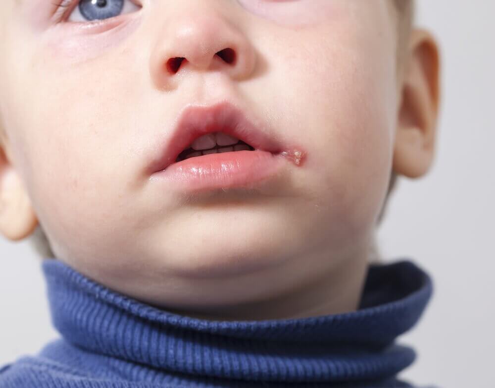 Small child with herpes