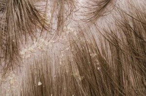 Tricky Ways To Use Aspirin For Dandruff