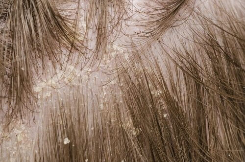 Tricky Ways To Use Aspirin For Dandruff