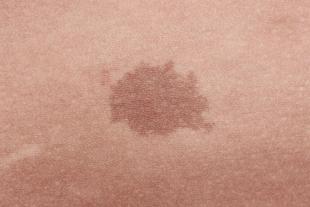 Dark Spots