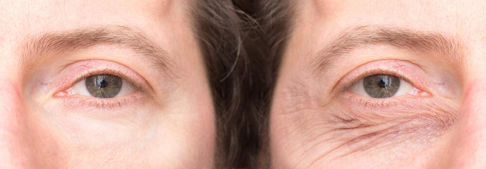 man with droopy eyelids