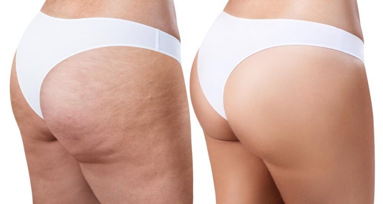 Get Rid of Cellulite With These Easy and Effective Home Remedies