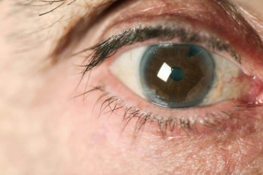 An eye with glaucoma.
