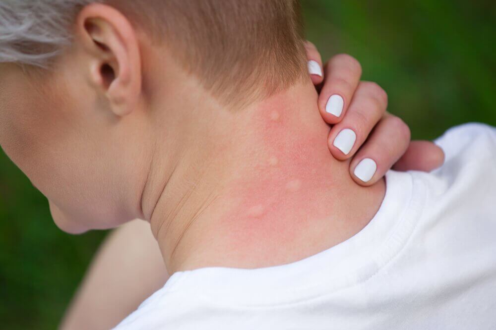 5 Remedies To Calm Insect Bite Allergies