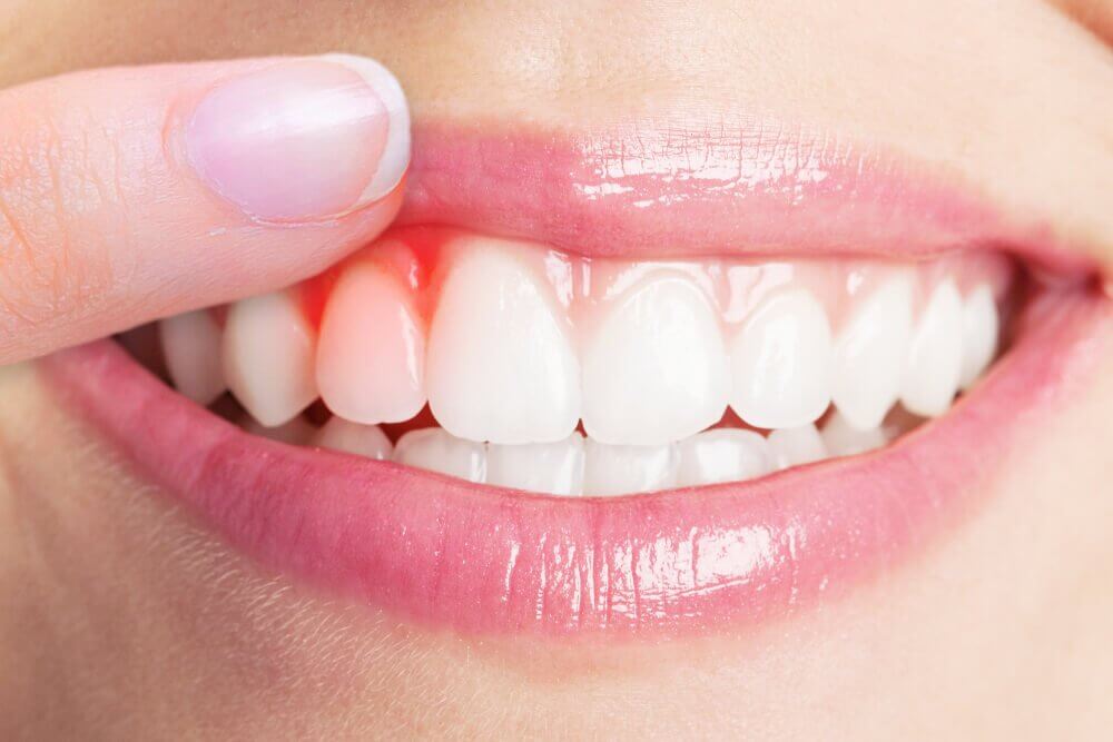 The Top 5 Remedies for Treating Gum Infections