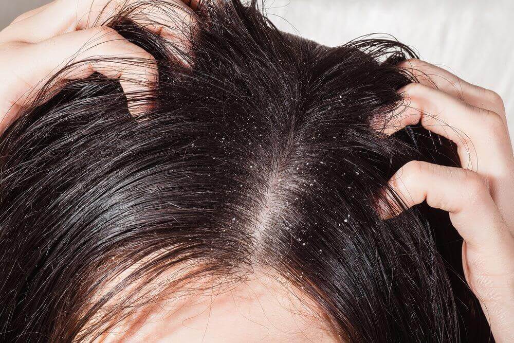 Scalp infections