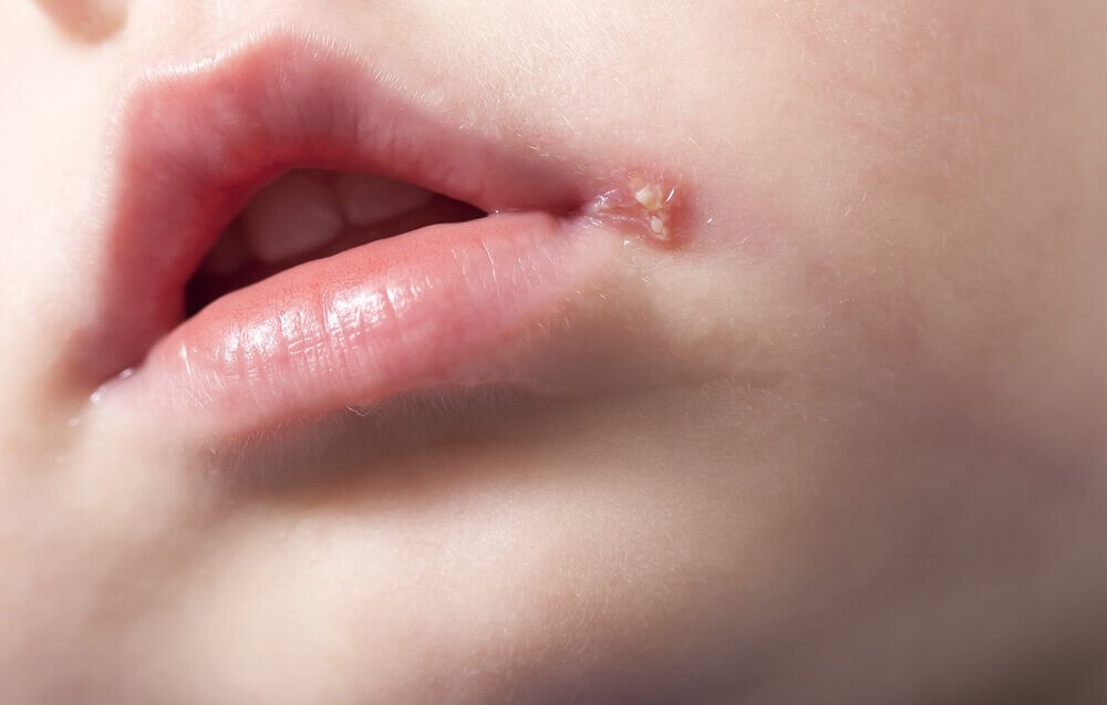 A child with a mouth blister, one of the symptoms of herpes in children