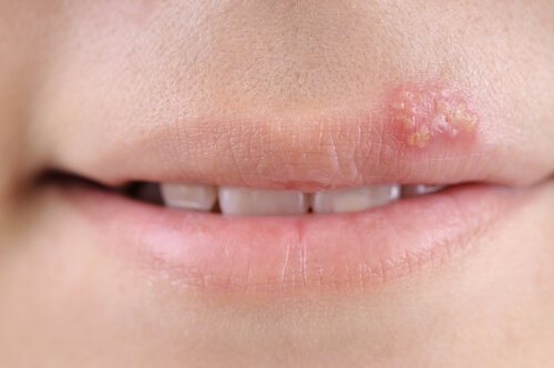 Child with a cold sore
