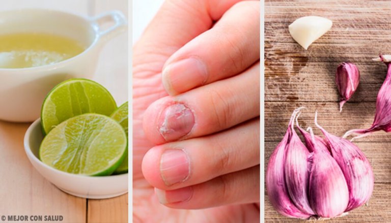 Home Remedies for Fungal Nail Infection