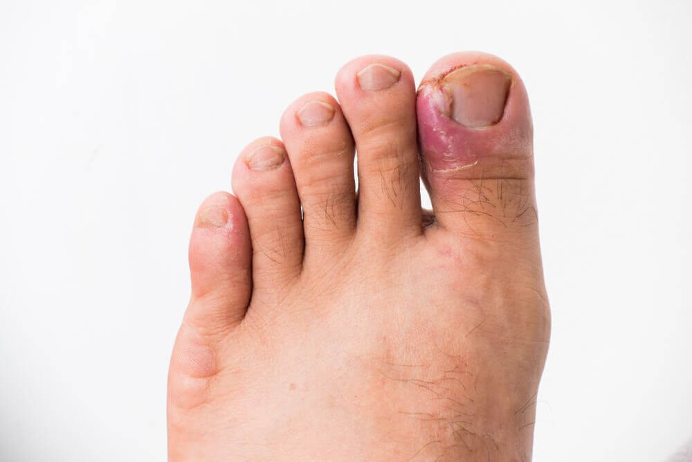 ingrown toenails