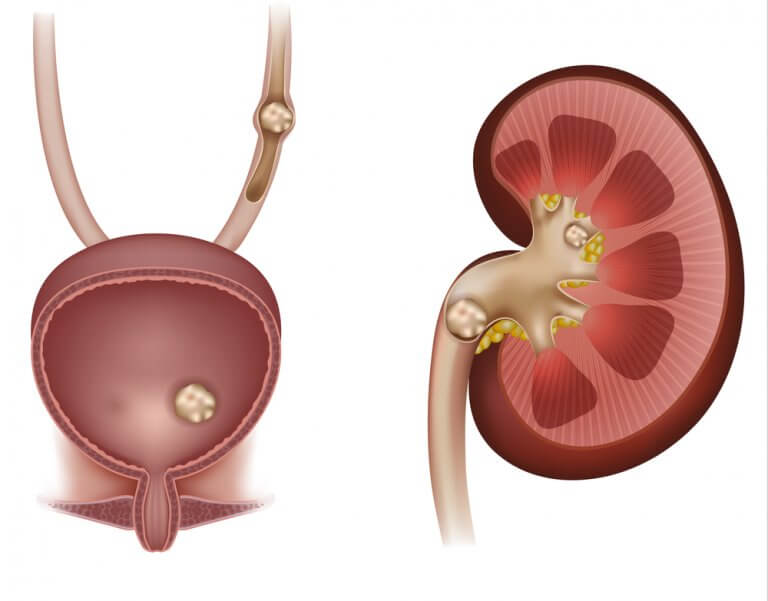 can apple cider vinegar cure kidney stones