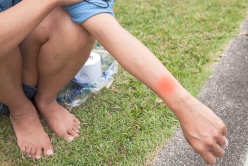 insect bite allergies