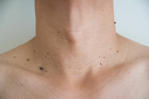 A neck with many moles.