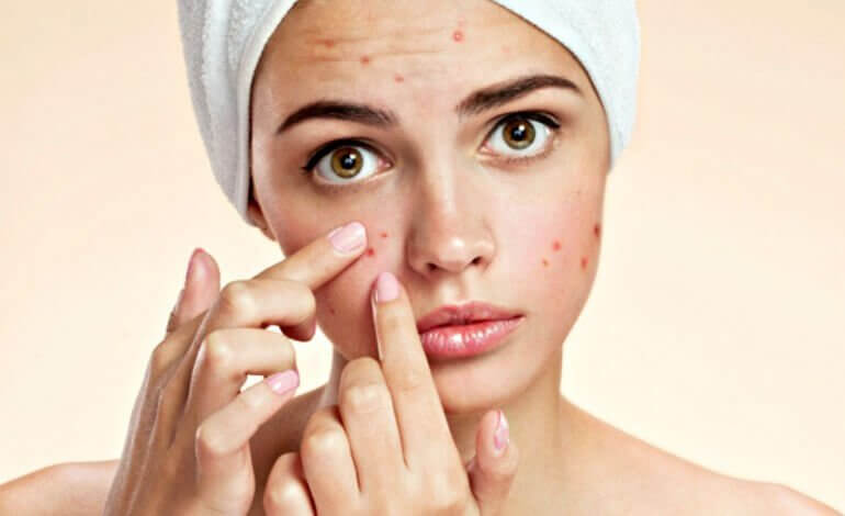 A woman with pimples.