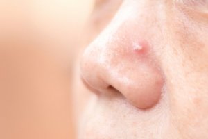 Get Rid of Pimples on Your Nose with These 4 Homemade Remedies
