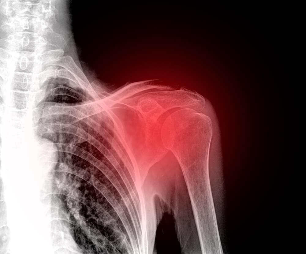 Relieve Your Shoulder Pain with These Homemade Remedies