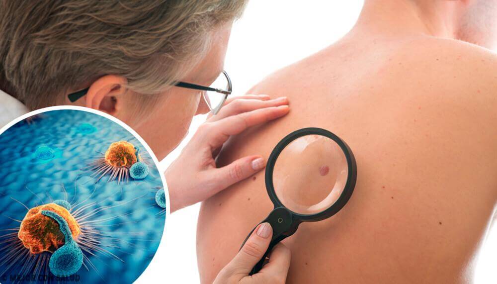 Skin Cancer Warning Signs and What to Do About Them