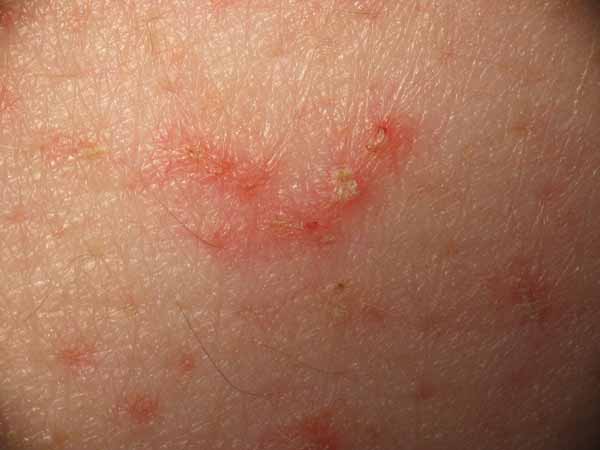 Rash.