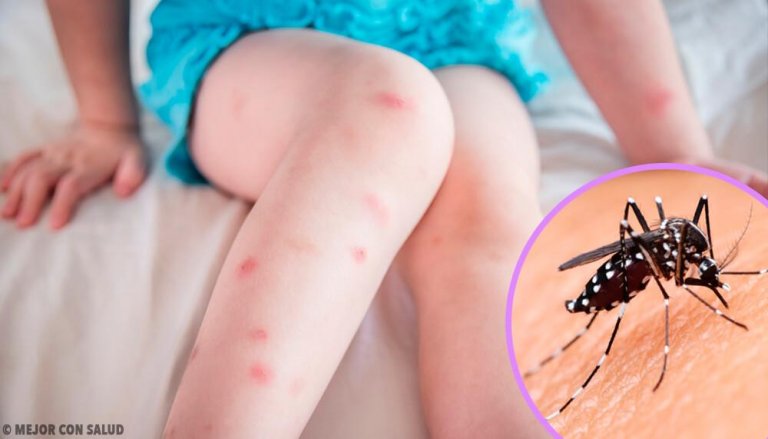 The 5 Most Common Insect Bites and How to Treat Them