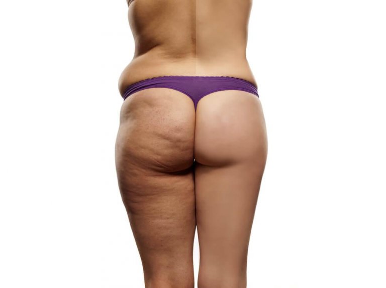 The Perfect Anti-Cellulite Diet Plan
