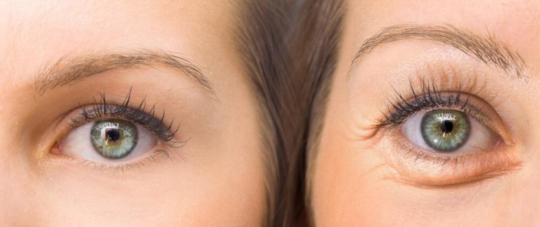 Tighten Your Droopy Eyelids With These 5 Natural Ingredients
