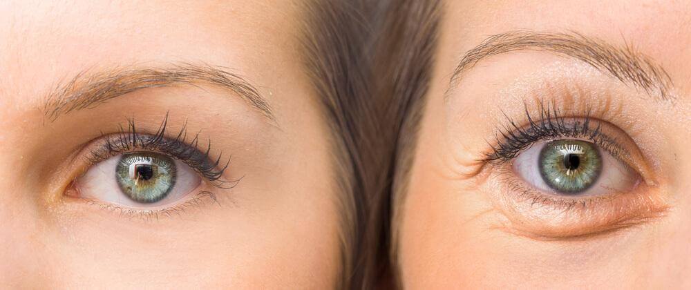 Eight Cosmetic Tricks for Hiding Droopy Eyelids - Step To Health