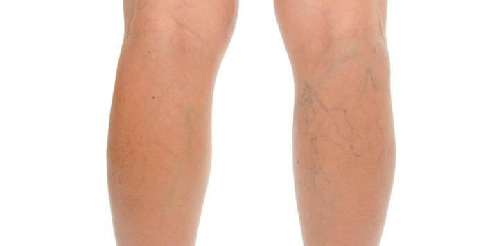 legs with varicose veins