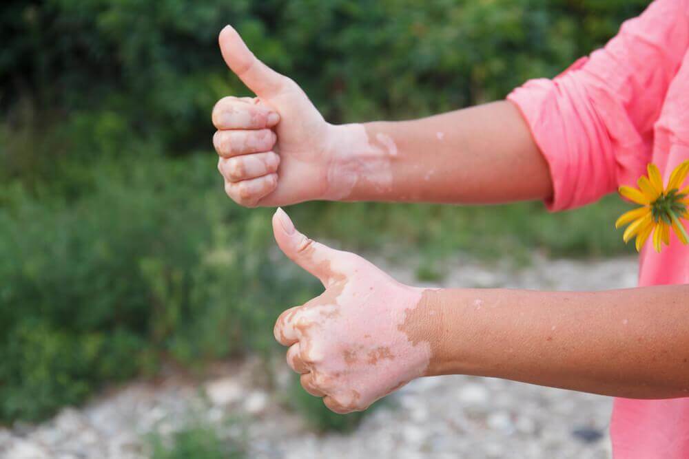 Autoimmune Diseases: Which Foods to Eat and Avoid