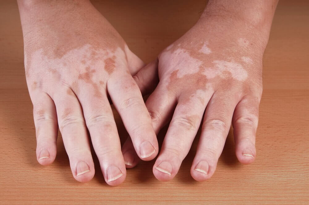 skin spots