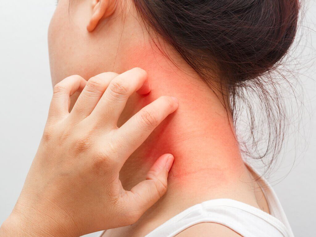Woman scratching a rash on her neck