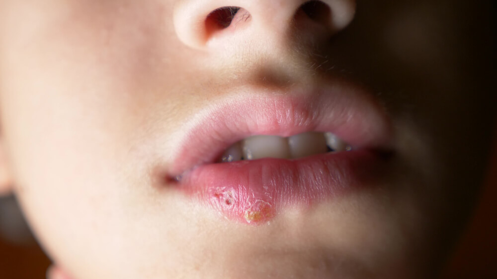 how-to-treat-herpes-in-children-step-to-health