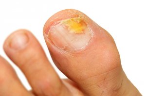 5 Essential Oils to Eliminate Onychomycosis