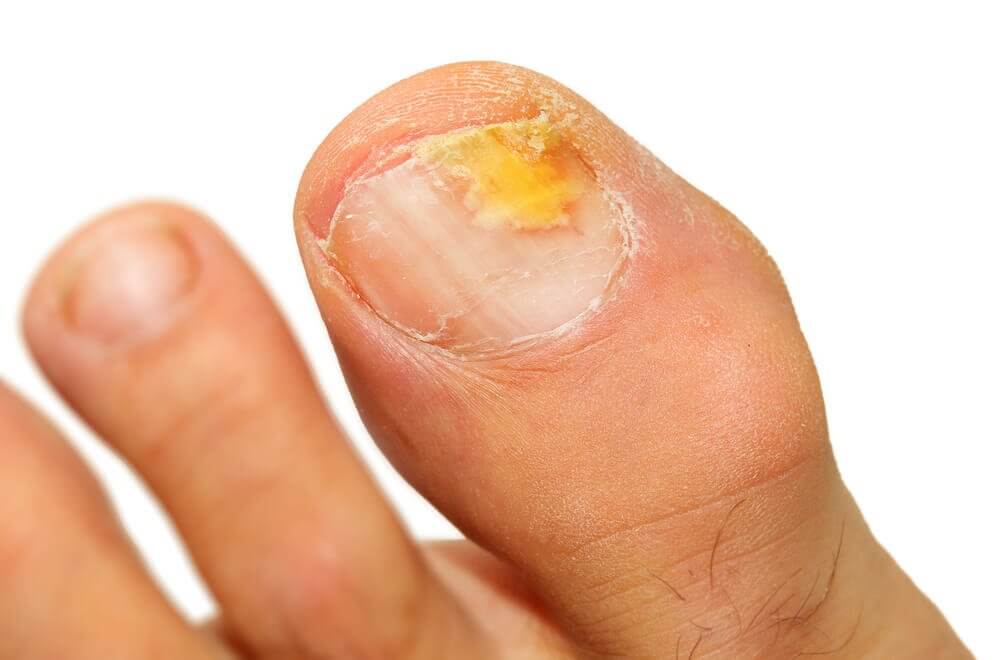 5 Essential Oils to Eliminate Onychomycosis