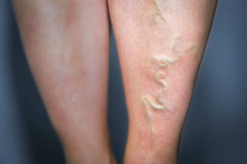 A person that needs to treat phlebitis.