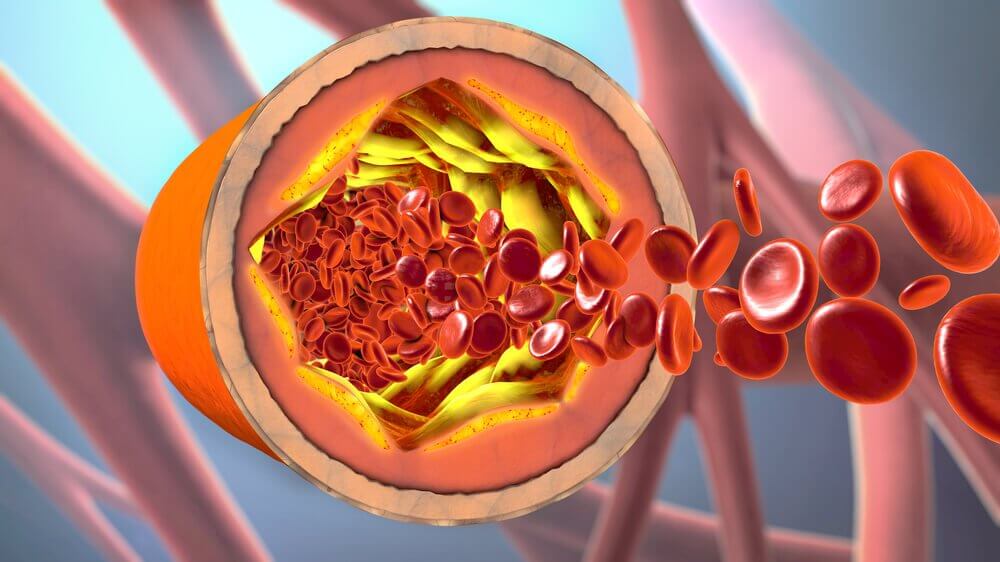Arterial blockages